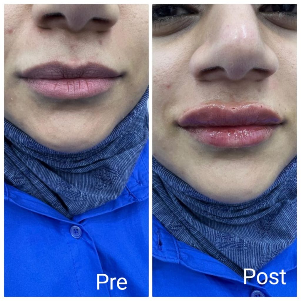 Lip filler injection